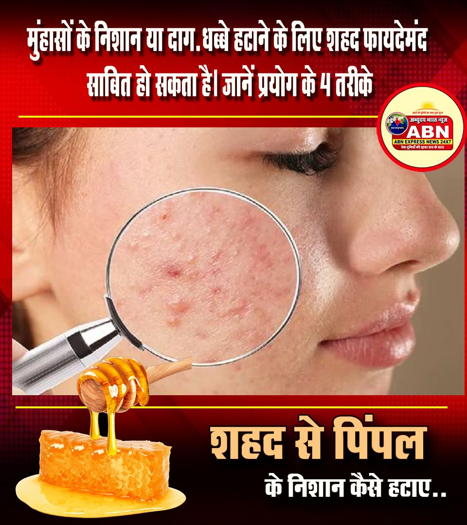 मुंहासों के दाग हटाने के लिए शहद का इन 4 तरीकों से करें इस्तेमाल, मिलेगी निखरी-बेदाग त्वचा